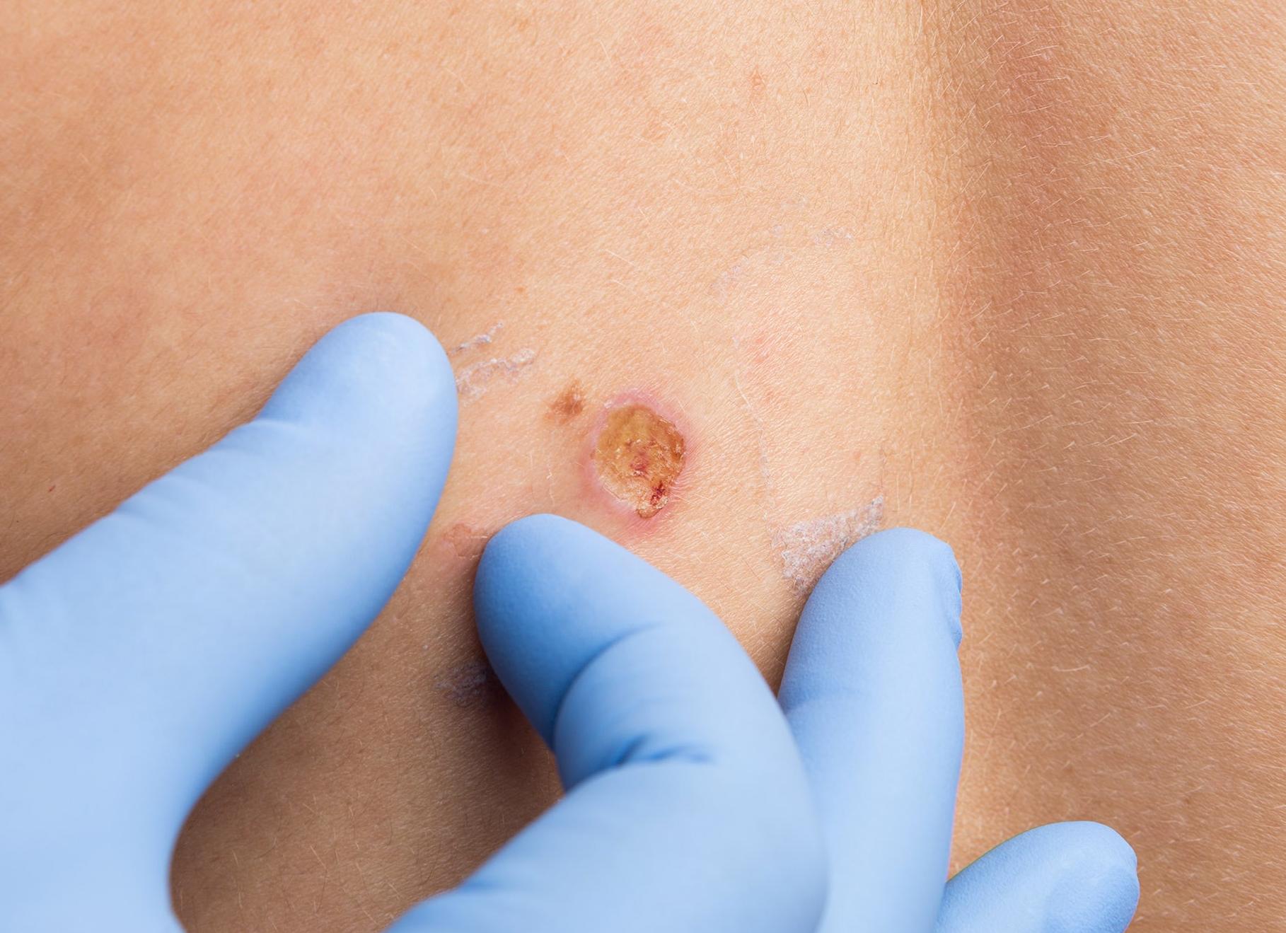 Что делать если оторвал родинку