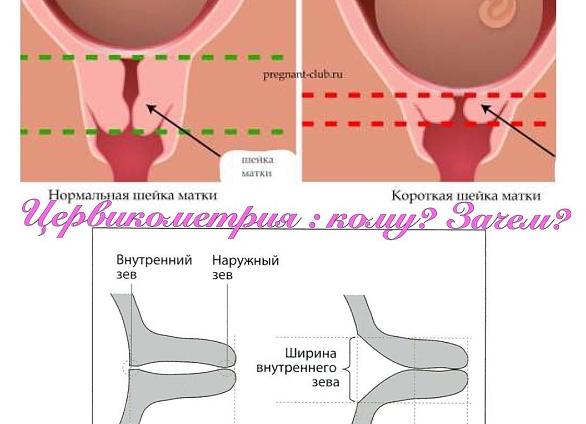 Цервикометрия это что