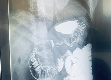 Барий для рентгена кишечника