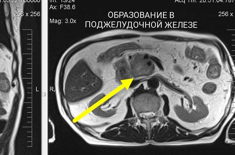 Мрт поджелудочной и печени