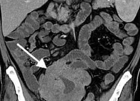 Мрт толстого и тонкого кишечника