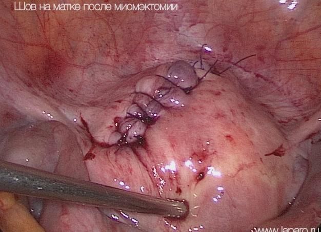 Миома матки после