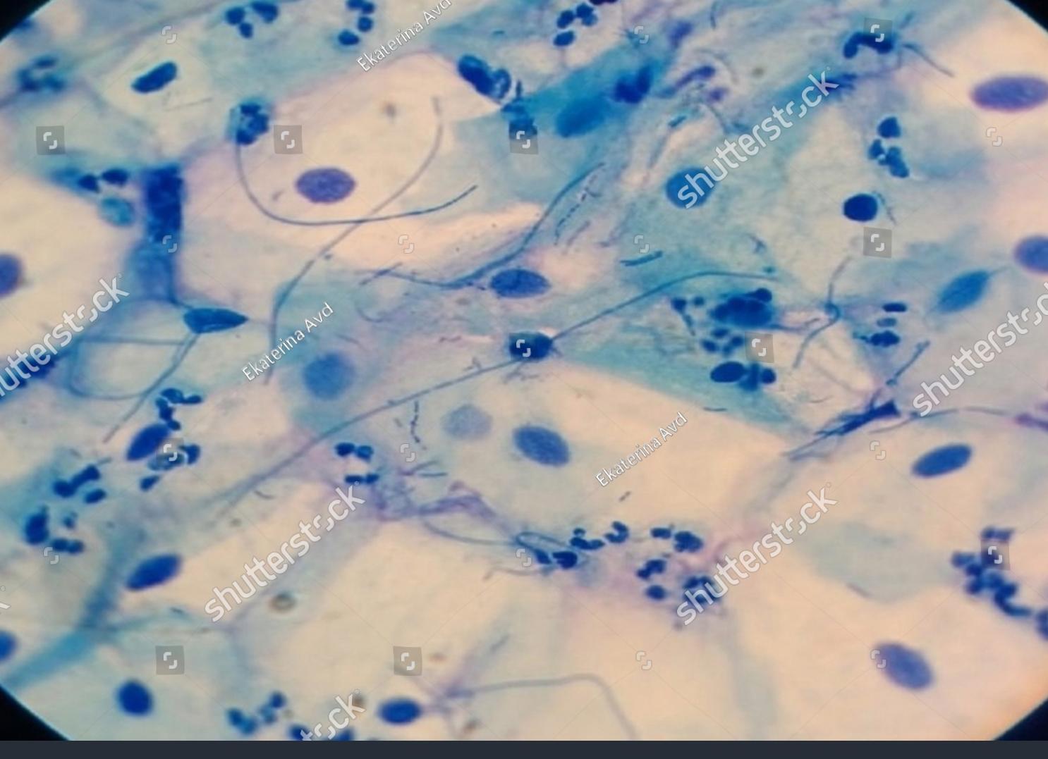 Лептотрикс в мазке Лептотрикс в мазке