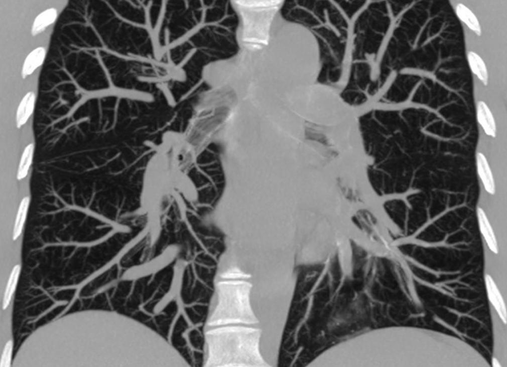 Кт органов грудной клетки с контрастированием Кт органов грудной клетки с контрастированием