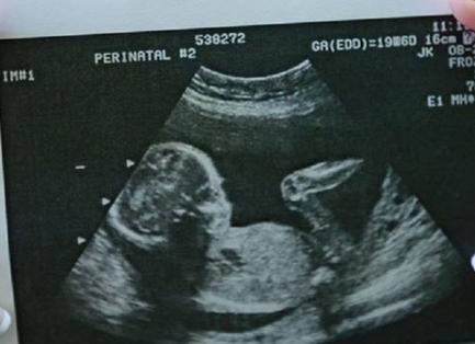 Когда узи показывает пол ребенка