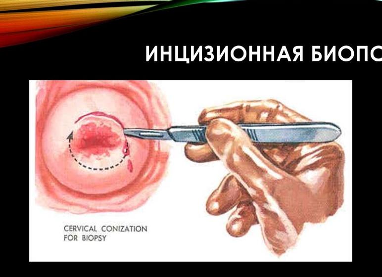 Инцизионная биопсия это
