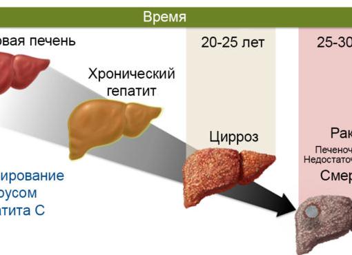 Хронический гепатит криптогенный