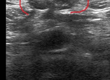 Грыжа на узи