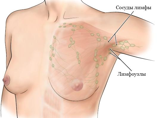 Гипоэхогенный лимфоузел под мышкой