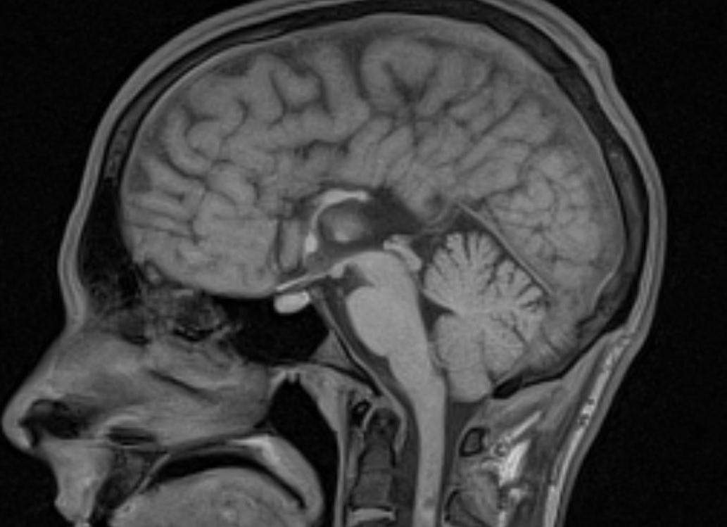 Дисгенезия мозолистого тела