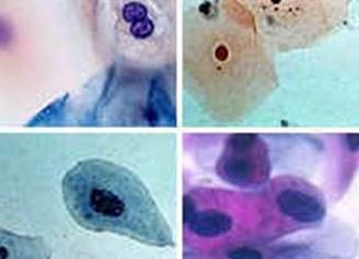 Цилиндрический эпителий в мазке из носа у ребенка