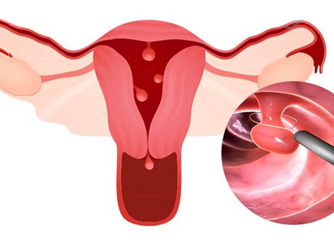 Что такое полипы