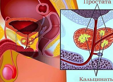 Что такое кальцинаты