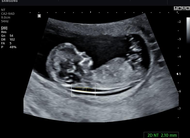 Что смотрят на первом скрининге в 12 недель