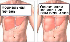 Гепатомегалия что это за заболевание