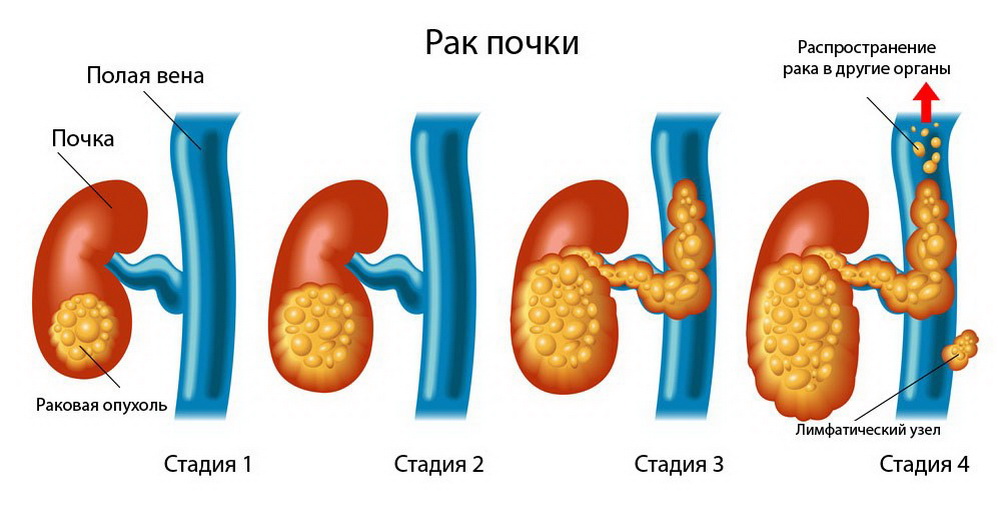 Как выглядят метастазы рака фото