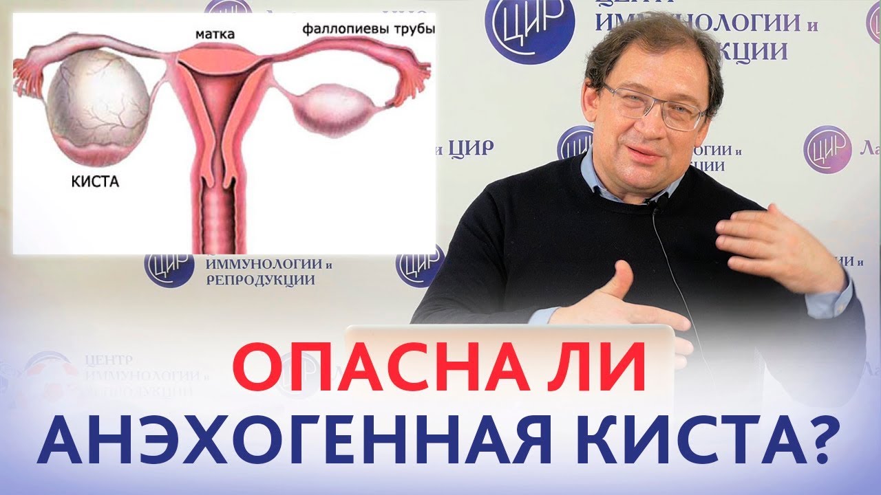 Киста яичника аваскулярная что это