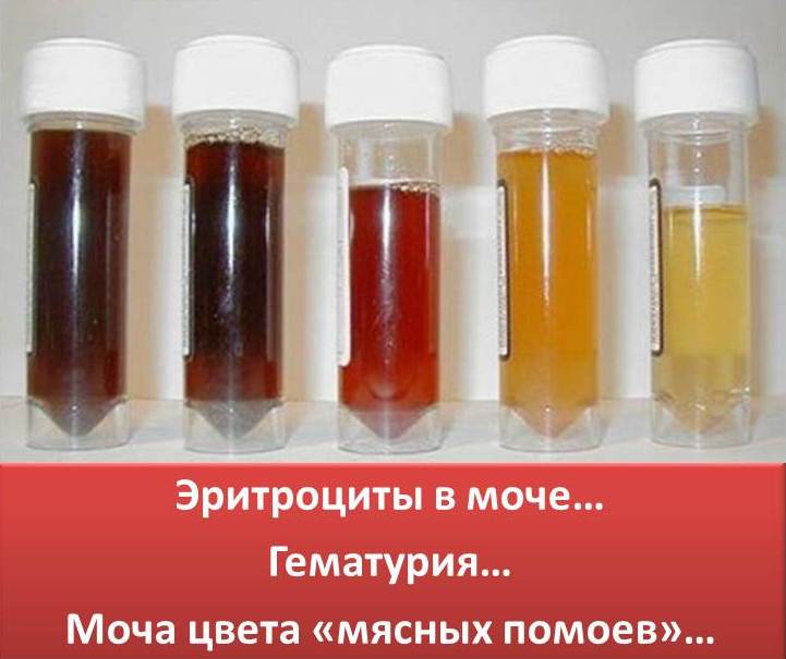 Красная моча причины у ребенка