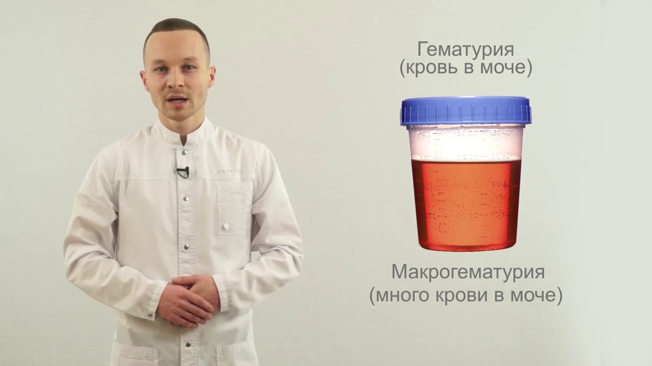 Макрогематурия у мужчин