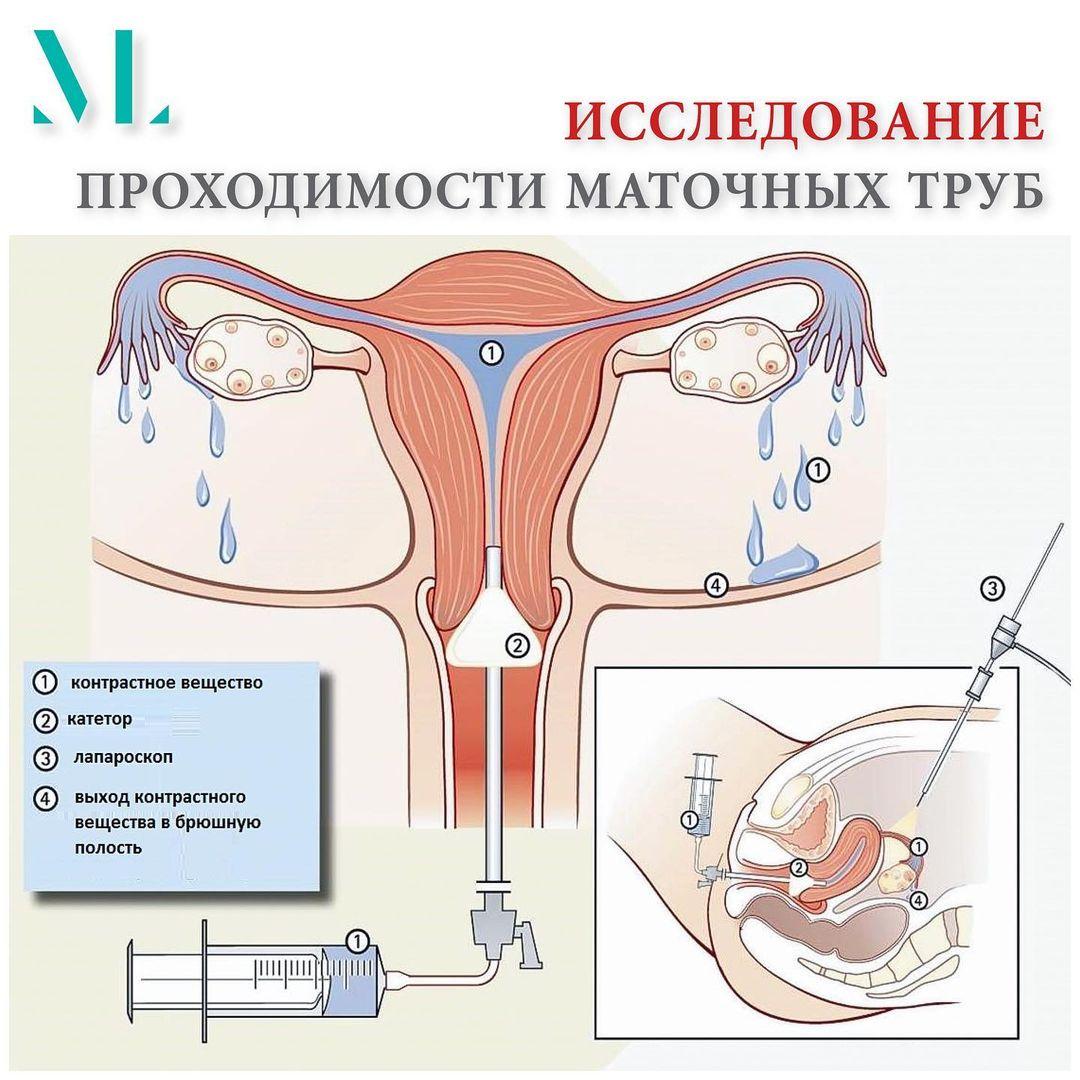 Маточные трубы как проверяют
