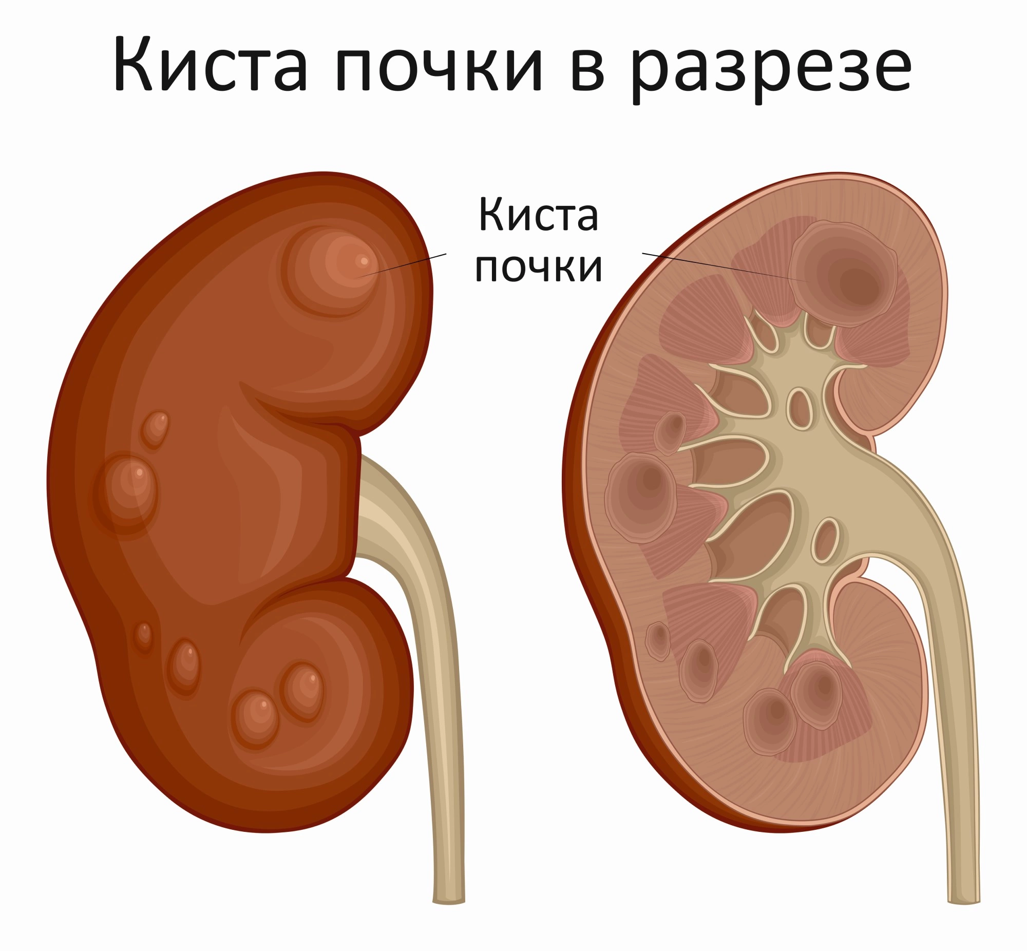 Множественные кисты в почках чем опасны