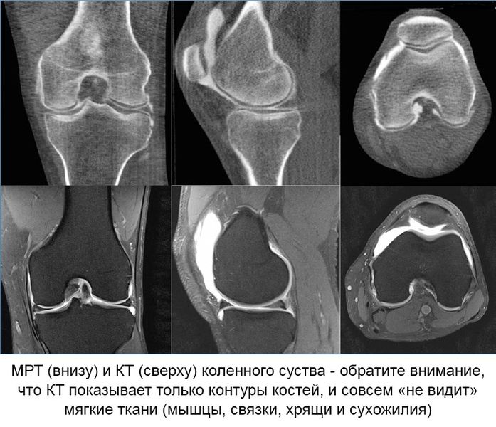 Мрт коленного сустава что покажет