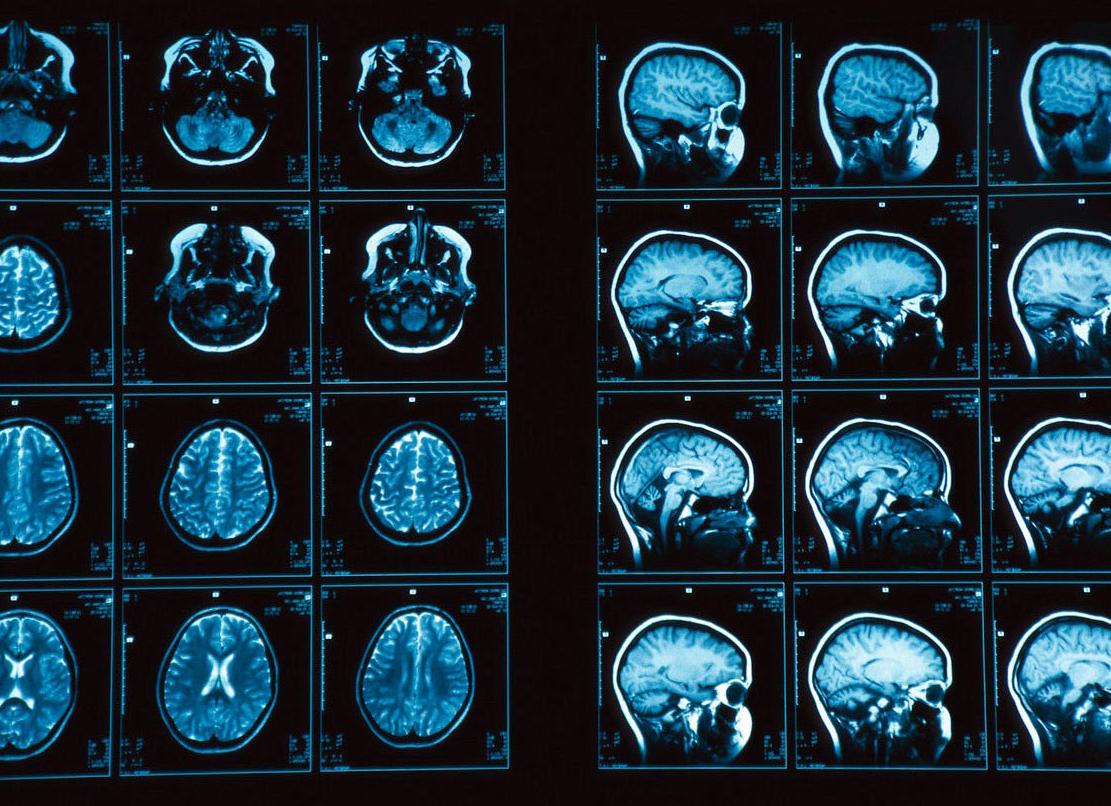 Мрт последствия для здоровья