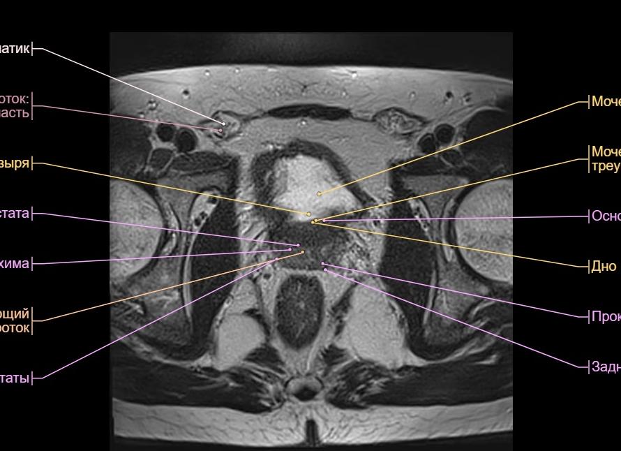 Мрт малого таза у женщин расшифровка