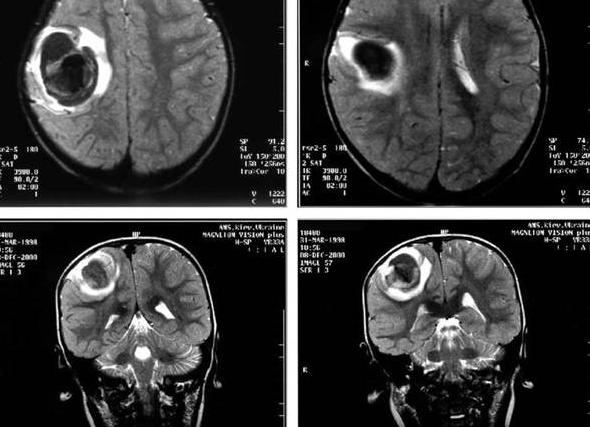 Мрт как расшифровать