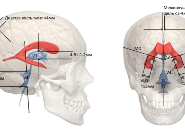 Межполушарная щель расширена у ребенка Межполушарная щель расширена у ребенка