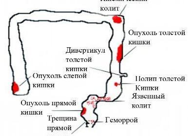 Кровь в кале у взрослого