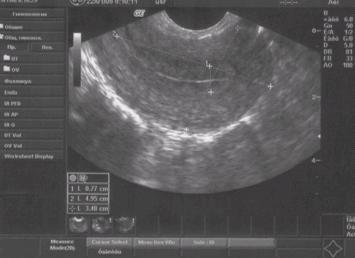 Как выглядит матка на узи Как выглядит матка на узи