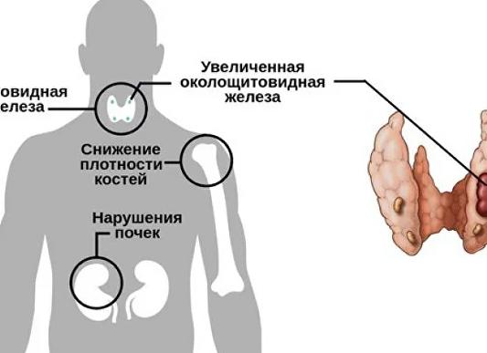 Как снизить паратгормон Как снизить паратгормон
