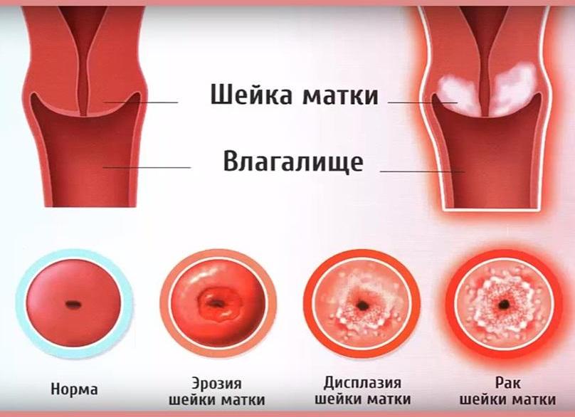 Как подготовиться к биопсии шейки матки Как подготовиться к биопсии шейки матки