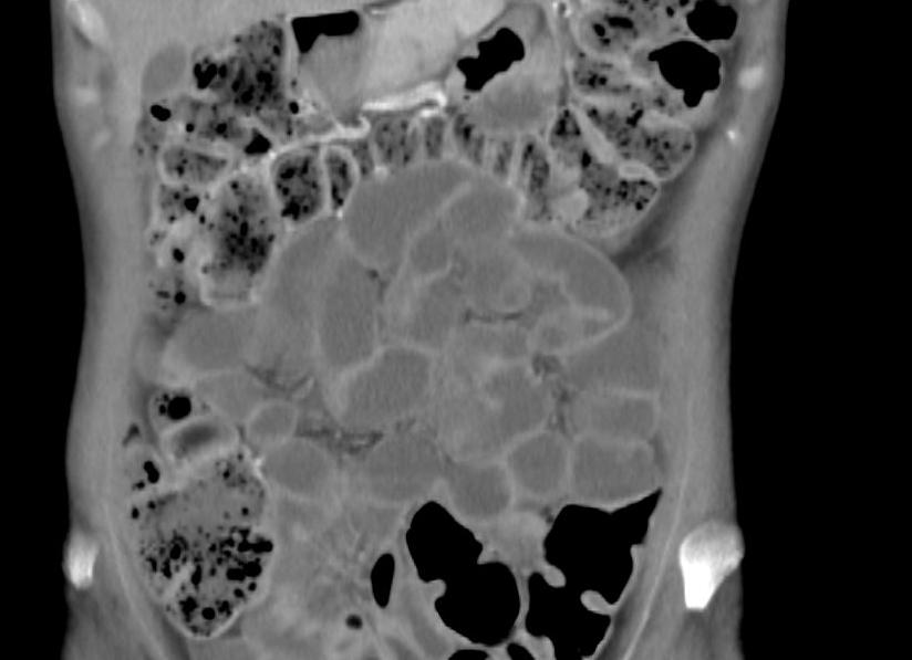 Исследование тонкого кишечника