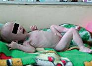 Гипотрофия плода 1 степени