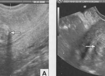 Гипоэхогенный узел в матке Гипоэхогенный узел в матке