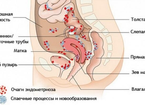 Эндометриоз если не лечить что будет