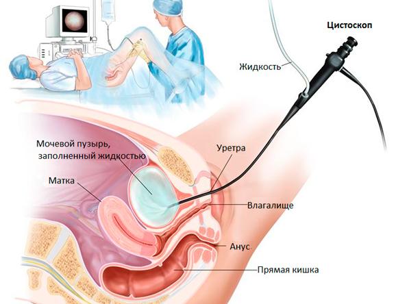 Цитология мочевого пузыря
