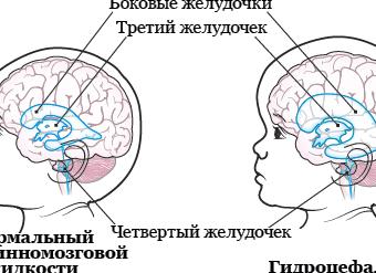 Что такое гидроцефалия Что такое гидроцефалия