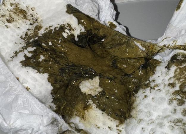 Черный кал от железа