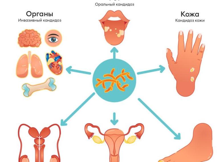 Бывает ли у мужчин молочница и какие признаки