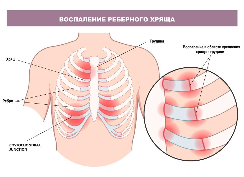 Болит ребро под молочной железой слева