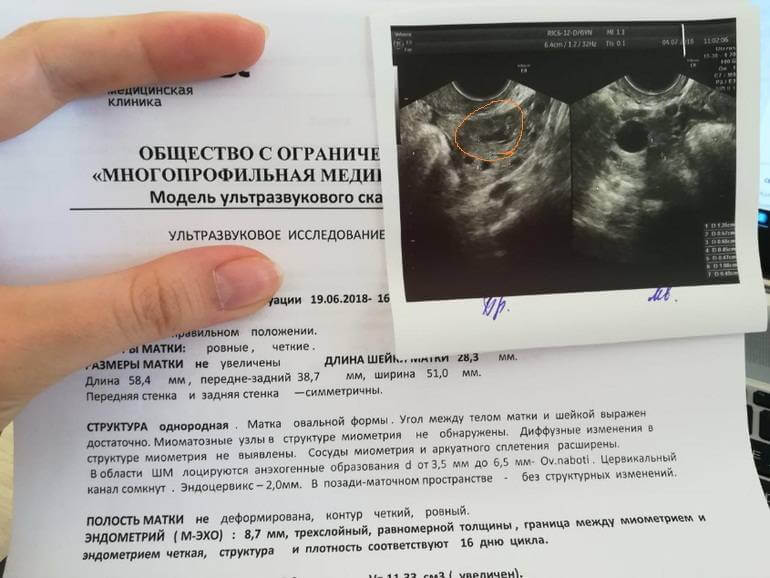 Как выглядит на узи желтое тело