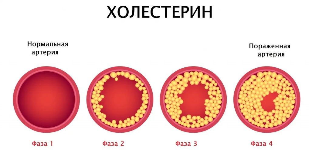 Липиды низкой плотности