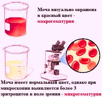 Микрогематурия что это такое