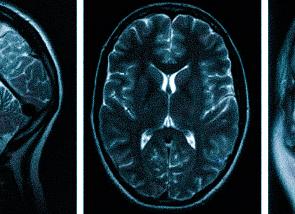 Мрт при головных болях
