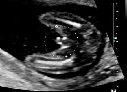 Может ли быть ошибка на узи при определении пола в 20 недель