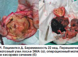 Миома матки и роды