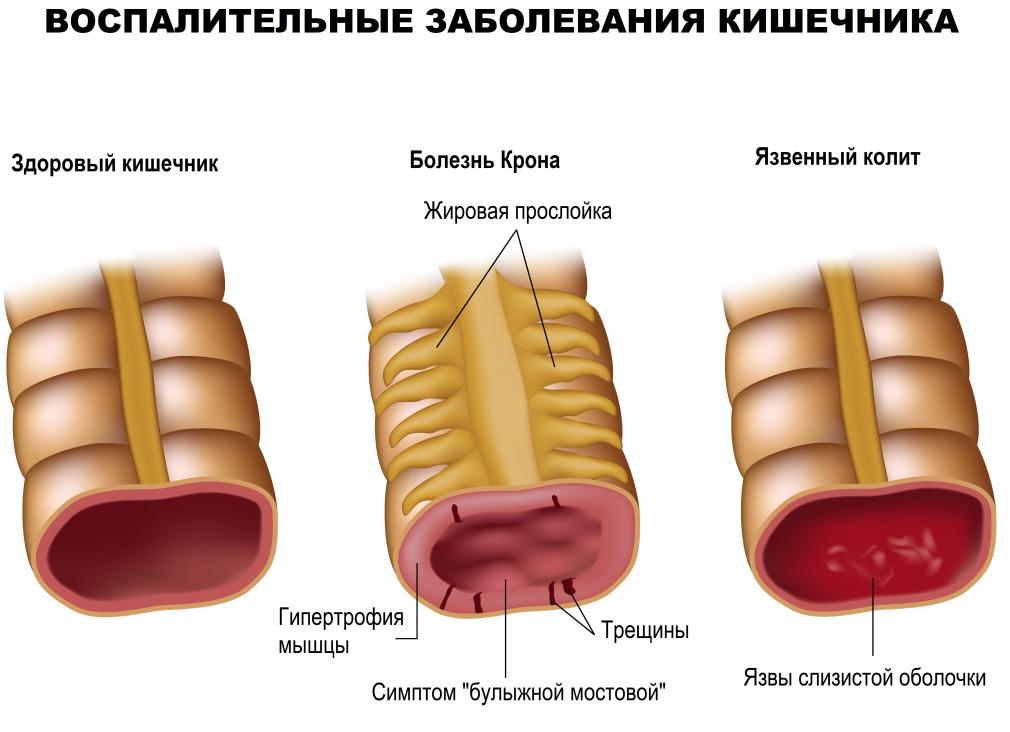 Какашки с кровью у ребенка